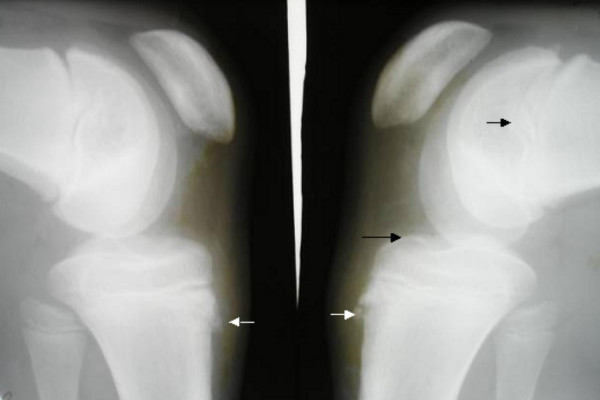 via Pediatric Rheumatology (see that little bone flopped up at the bottom?  That's what I did). 